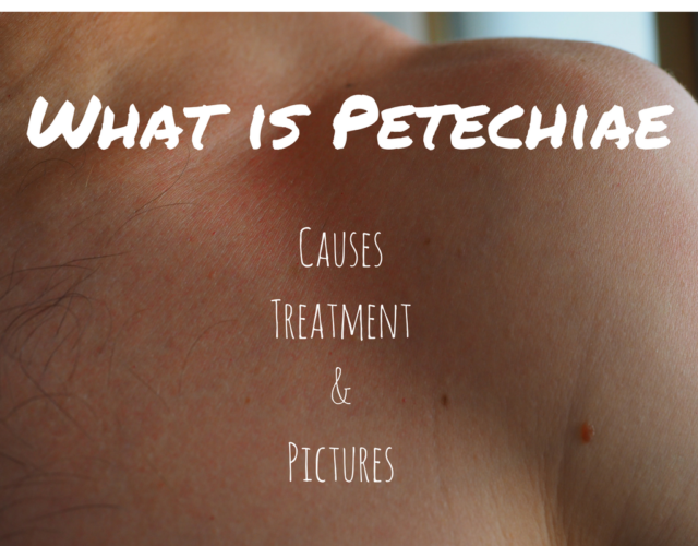Pinpoint Red Dots on Skin, This Could Be Petechiae